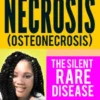 Avascular Necrosis (Osteonecrosis): The Silent Rare Disease: My Story